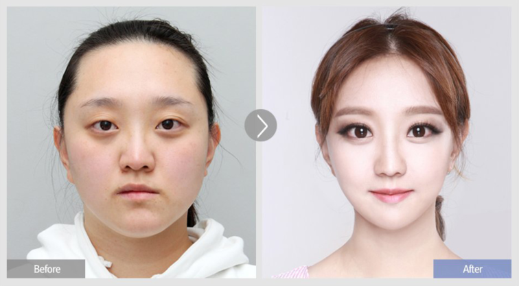 韩国faceline整形外科双眼皮整形对比日记