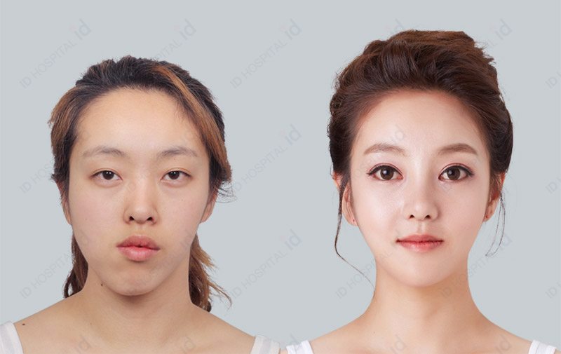 韩国ID整形外科眼部整形前后对比图