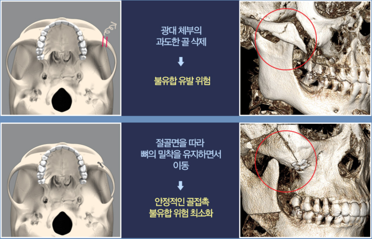 韩国布拉德整形医院颧骨缩小手术前后对比