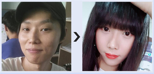 韩国美迪莹下颌角整形对比案例