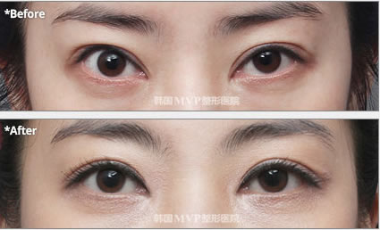 韩国眼睛修复好医院收集（五）：MVPVS半岛眼