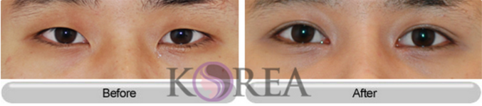 韩国korea整形外科割双眼皮属于什么风格？