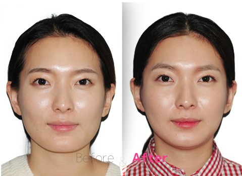 韩国拉菲安整形外科下颌角案例