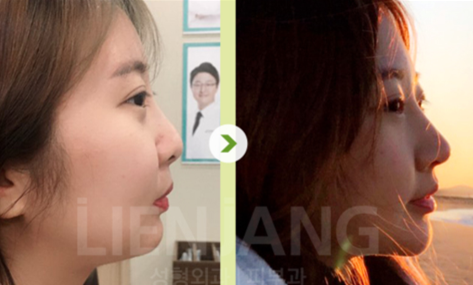 韩国丽延长整形外科医院鼻子整形图片