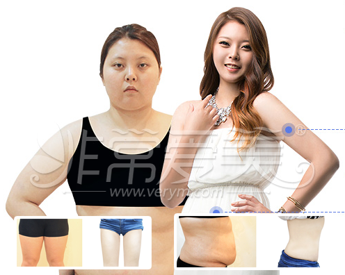 韩国吸脂好医院分析：丽颖和wiz整形谁更强？