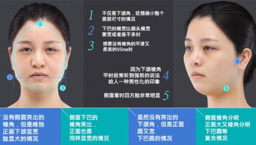 韩国德莱茵下颌角整形怎么样，术后效果明显么？