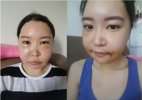 韩国GNG整形外科下颌角真人秀术后一周