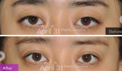 4月31双眼皮修复手术案例