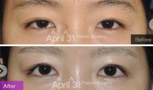 4月31双眼皮修复手术真人案例