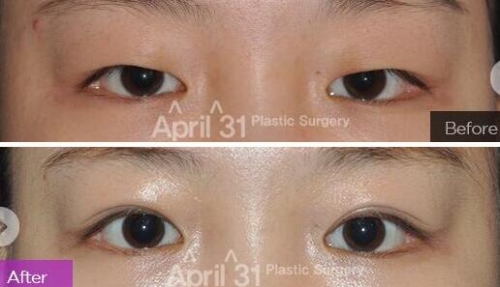 4月31双眼皮修复手术效果