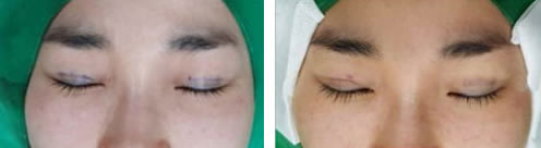 韩国MIGO整形外科双眼皮手术特点展示
