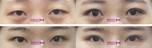 韩国MIGO整形外科双眼皮案例对比