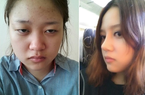 韩国AHN整形外科隆鼻案例展示