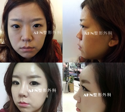 韩国AHN整形外科真人隆鼻案例对比