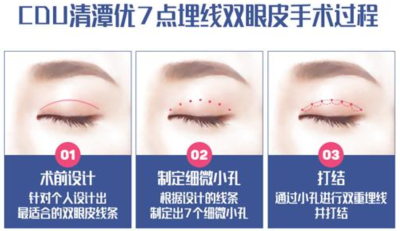 韩国清潭优整形医院7点埋线双眼皮能保持多长时间？
