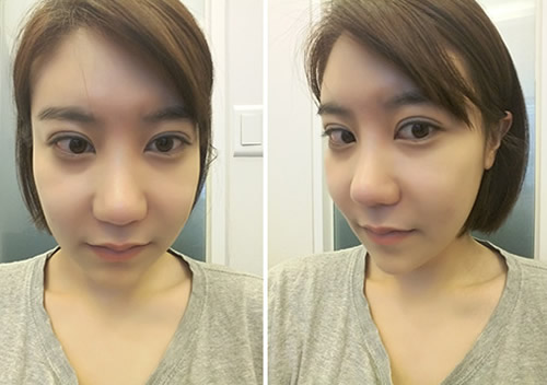 韩国加美整形外科眼鼻修复术前照片