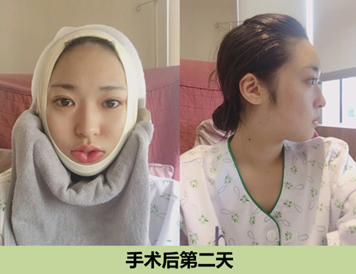 韩国ID下颌角整形术后第二天恢复图