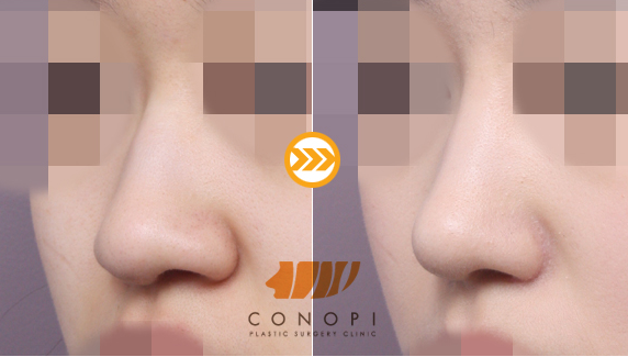 韩国高诺鼻CONOPI整形外科隆鼻案例