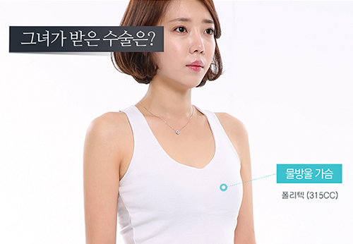 韩国JAYJUN整形外科隆胸术前照片展示