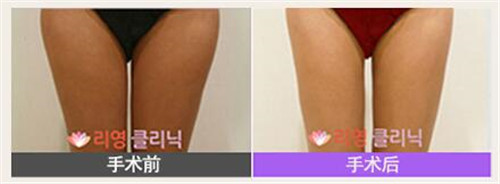 韩国维德整形外科大腿吸对比
