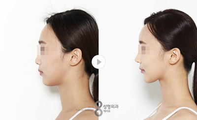 韩国A特整形外科面部提升案例对比