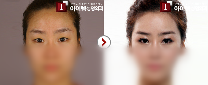 韩国爱婷整形外科双眼皮整形案例对比