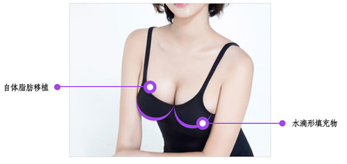 韩国A特整形外科隆胸特点展示