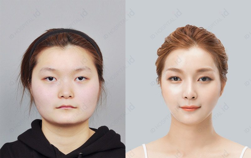 韩国ID整形外科假体隆鼻对比案例