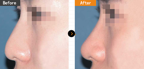 韩国玛博尔整形外科隆鼻案例对比图