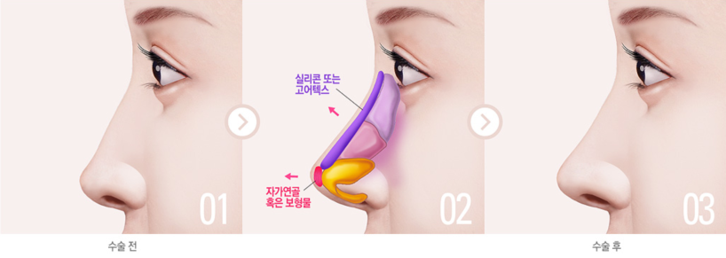 韩国丽丝塔隆鼻技术怎么样