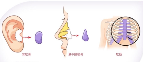 韩国BK医院鼻修复方法