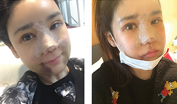 在韩国JAYJUN整形外科做了轮廓+眼鼻整形