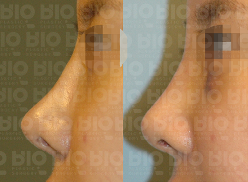 韩国BIO整形外科隆鼻案例对比