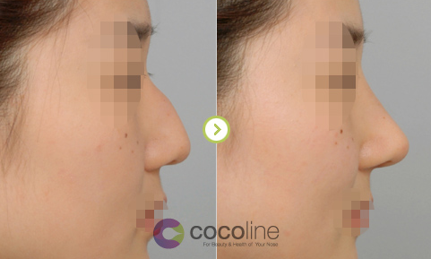 cocoline整形外科隆鼻案例对比