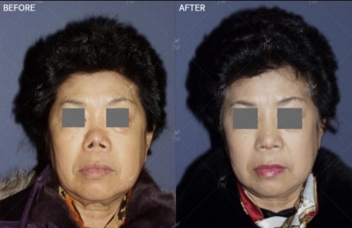 韩国JW整形医院鼻修复案例