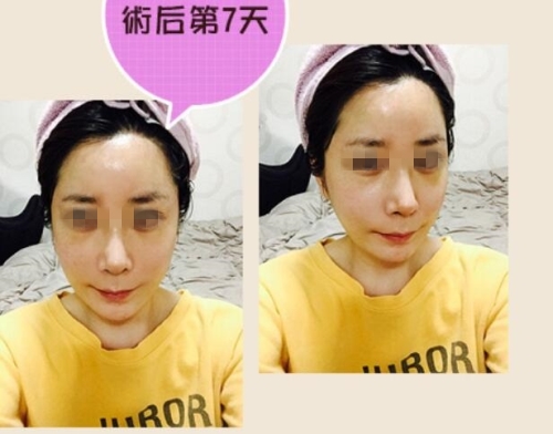 韩国自然主义整形外科眼鼻综合+脂肪填充恢复后记！