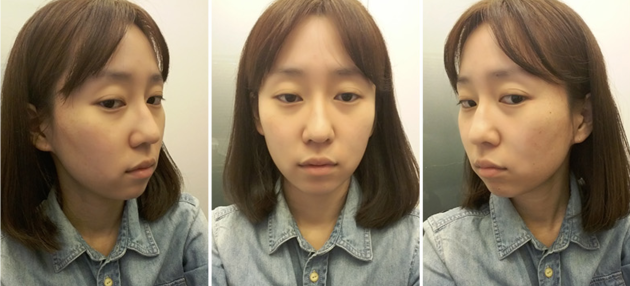 韩国加美割双眼术前照片