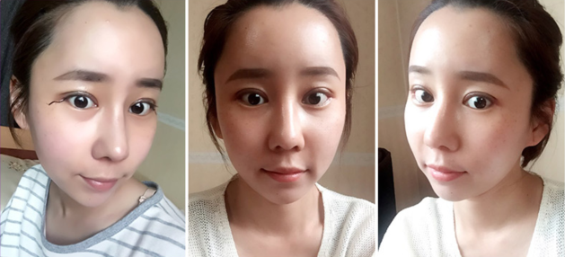 真实用户恢复过程揭秘 韩国加美割双眼皮技术