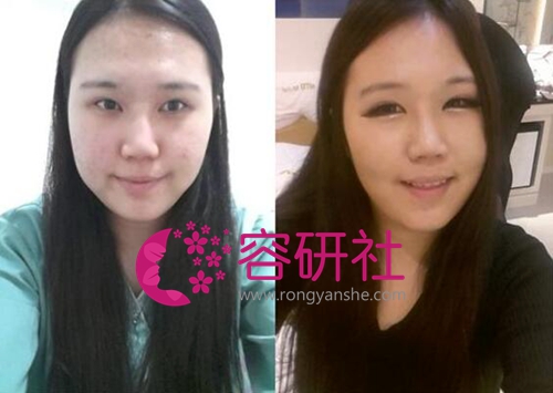 韩国巴诺巴奇整形医院吴昌铉面部轮廓手术，微笑更迷人