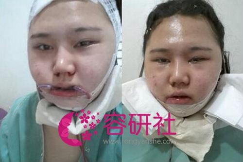 韩国巴诺巴奇整形医院吴昌铉面部轮廓手术，微笑更迷人