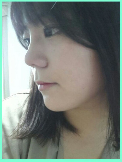 韩国歌柔飞假体隆鼻术后照片