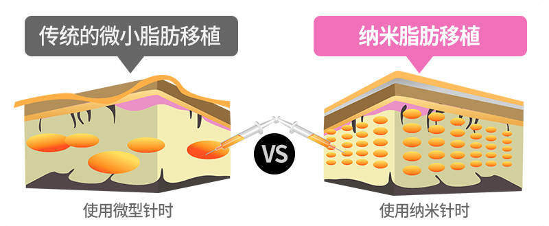 韩国ID自体脂肪填充示意图 韩国ID自体脂肪填充示意图
