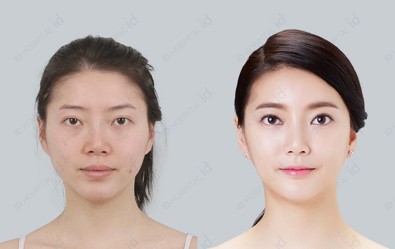 韩国ID脂肪填充前后对比图 韩国ID脂肪填充前后对比图