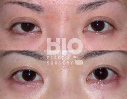 韩国BIO双眼皮修复对比图