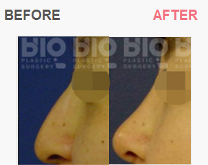 BIO鼻部修复手术案例