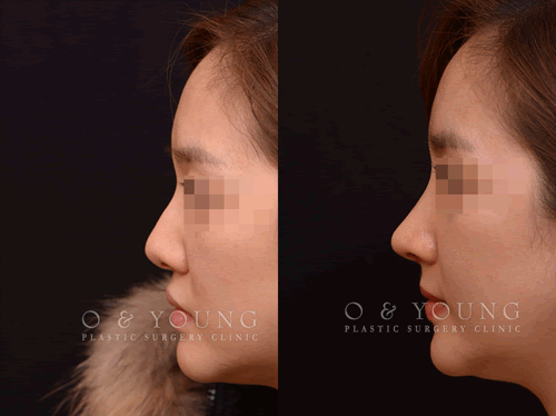 韩国O&young隆鼻手术效果对比