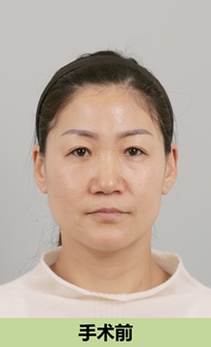 韩国ID拉皮手术前照片