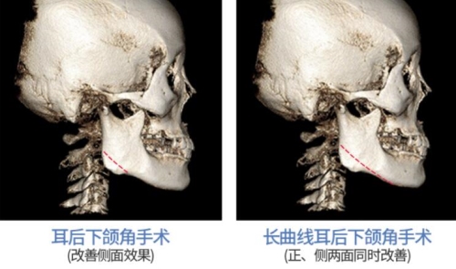 下颌角手术x光示意图