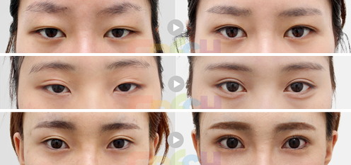 韩国芙莱思整形外科双眼皮修复案例对比