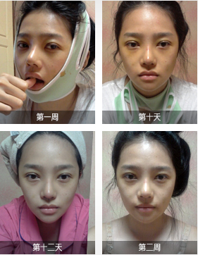 韩国颧骨下颌角整形术后恢复图